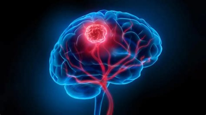Andrea Mitchell Brain Tumor