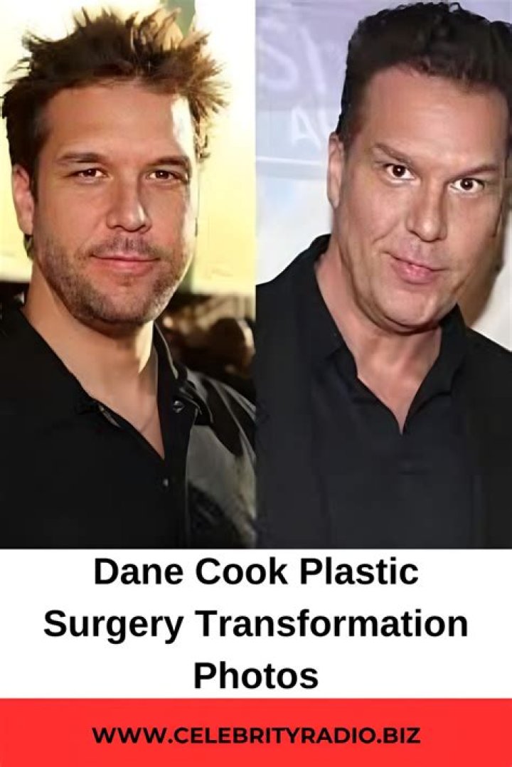 Dane Cook Plastic Surgery With Before And After Photos |